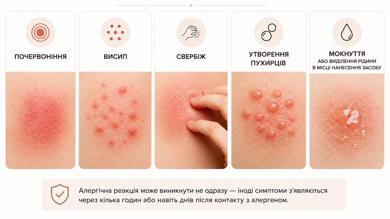 Як проявляється алергія